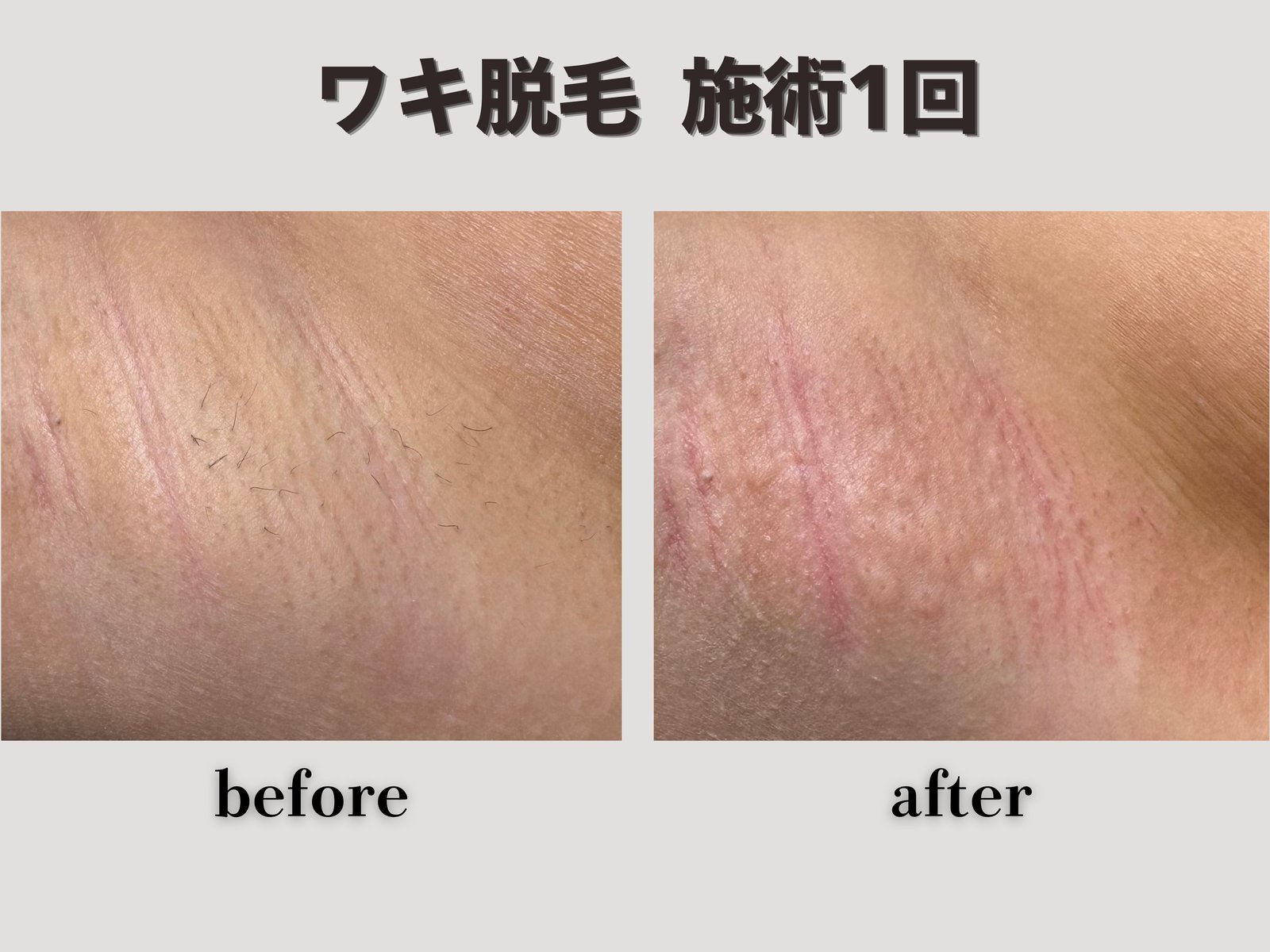 ワキ脱毛 施術1回 Before/After