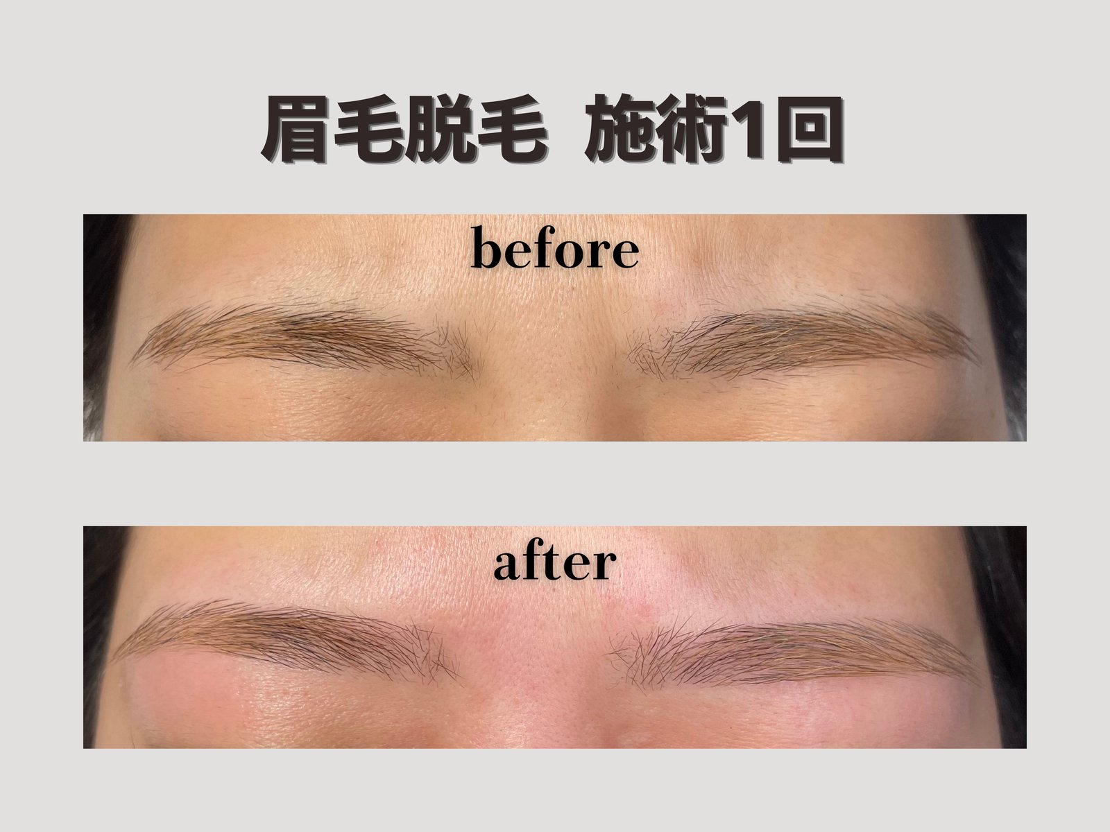 眉毛脱毛 施術1回 Before/After