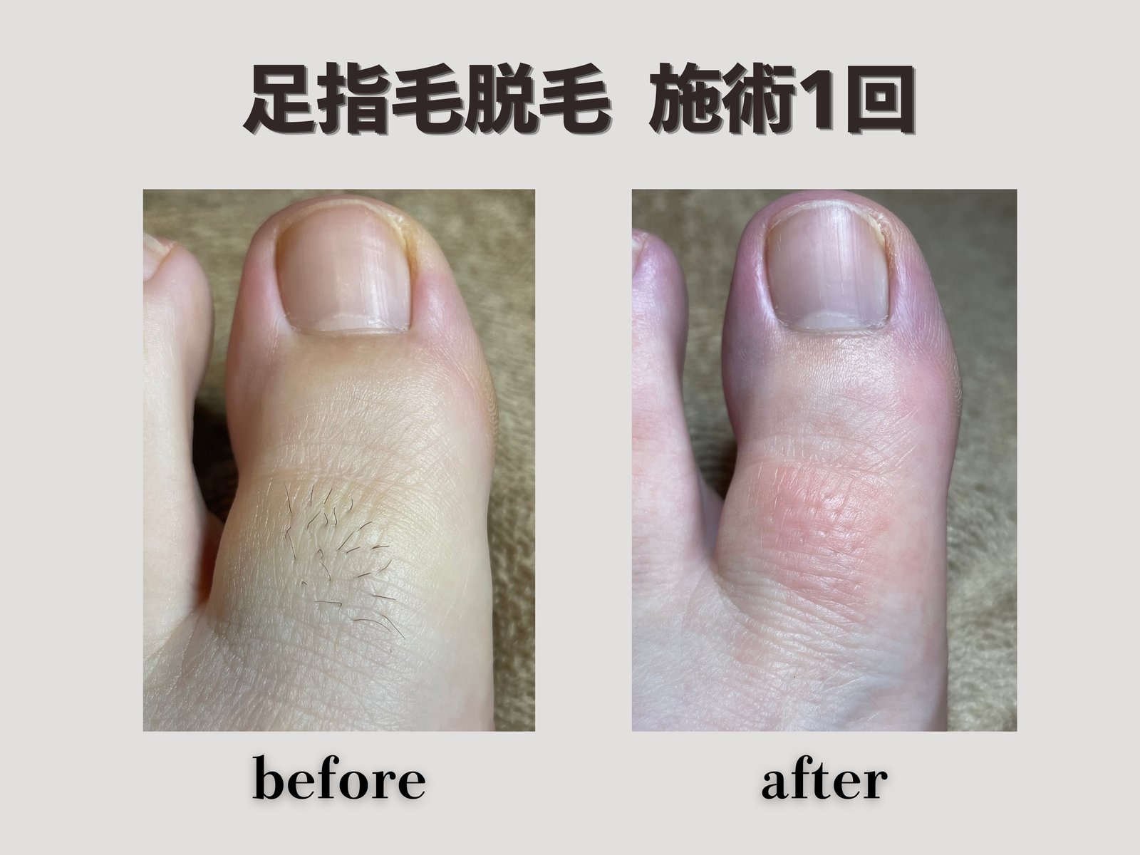 足指毛脱毛 施術1回 Before/After