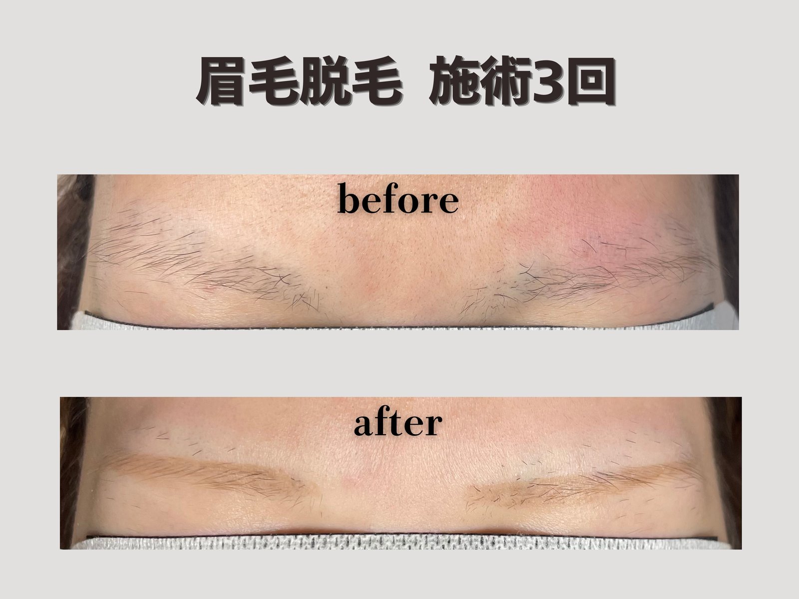 眉毛脱毛 施術3回 Before/After