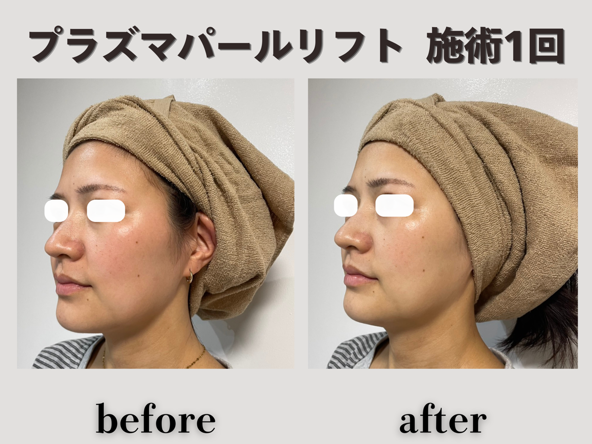 プラズマパールリフト 施術1回 横顔 Before/After