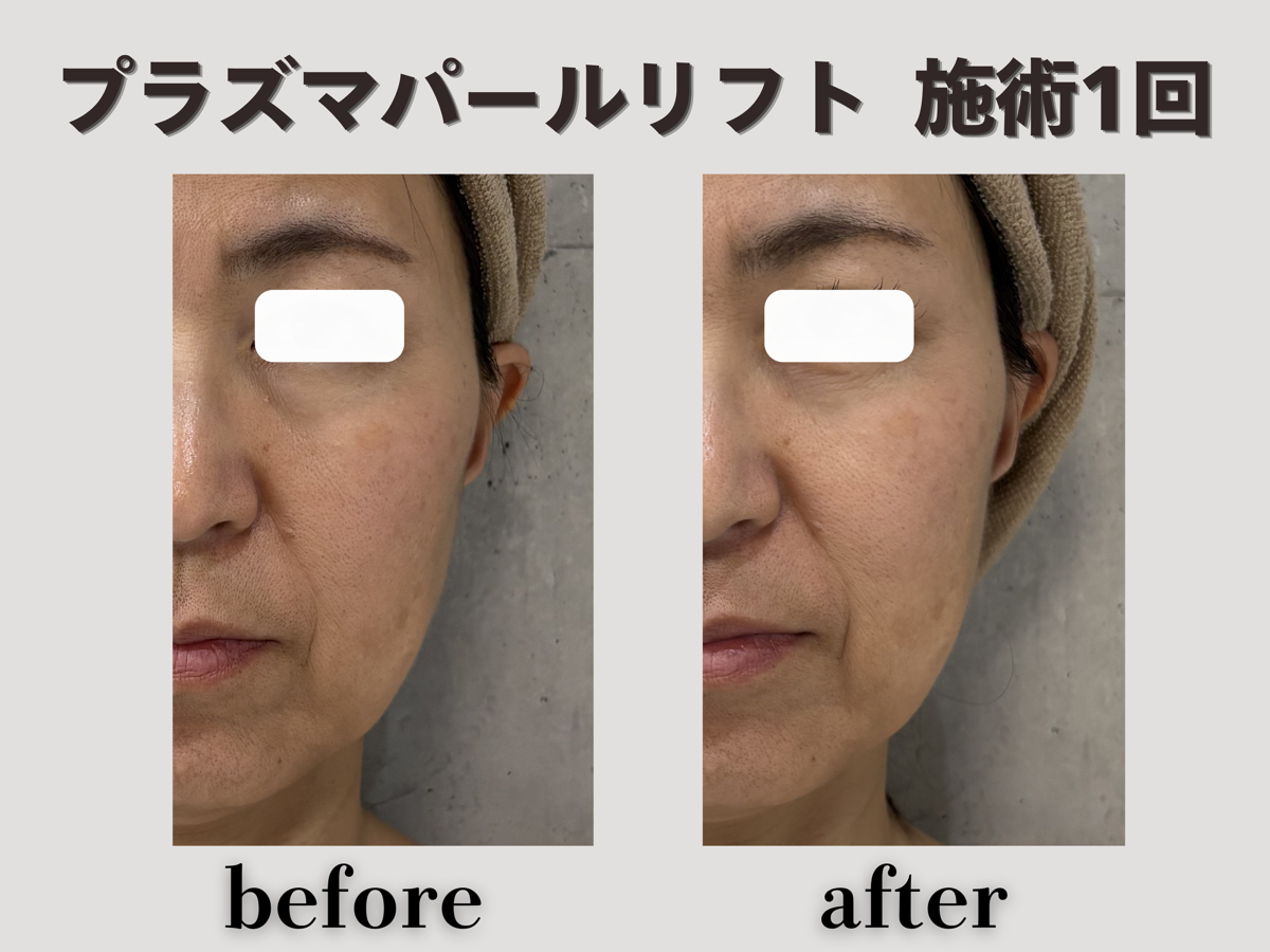 プラズマパールリフト 施術1回 クローズアップ Before/After