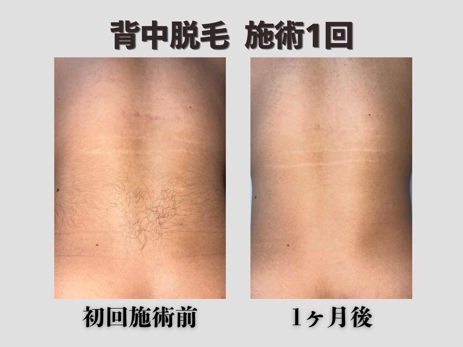 背中脱毛 施術1回 Before/After