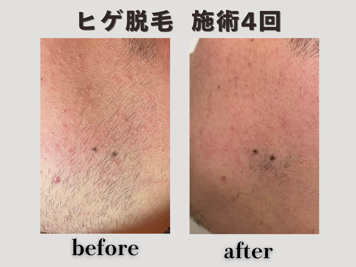 ヒゲ脱毛 施術4回 Before/After
