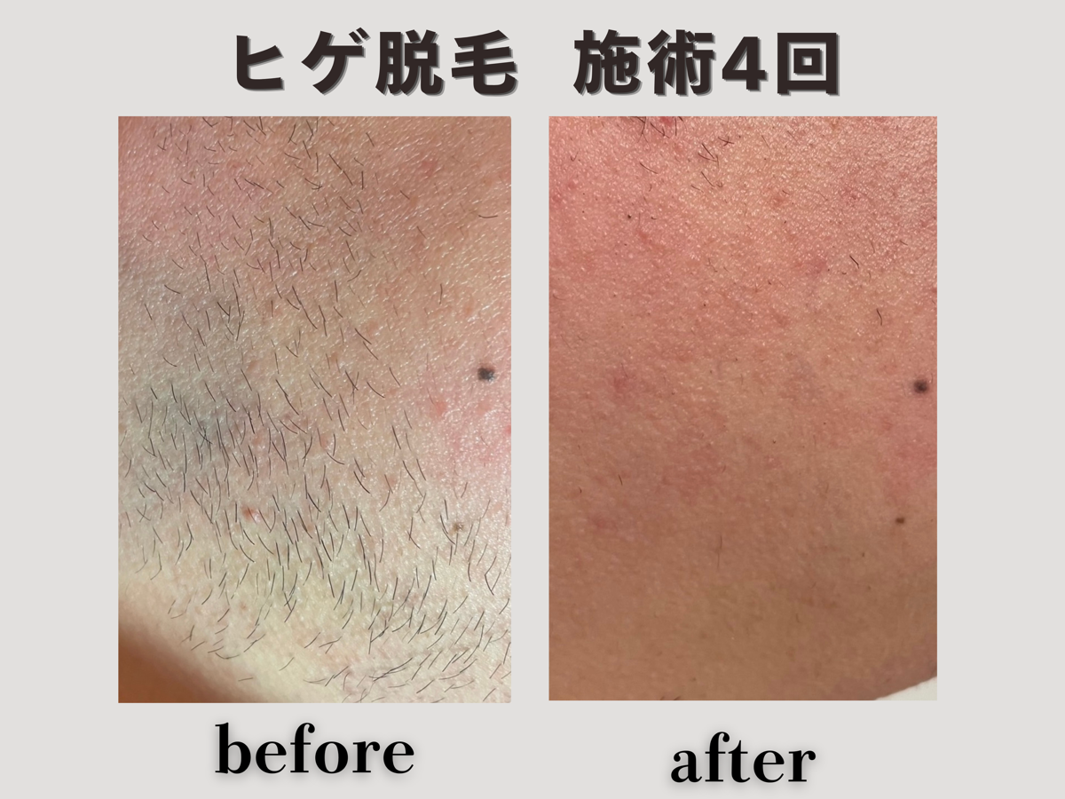 ヒゲ脱毛 施術4回 Before/After