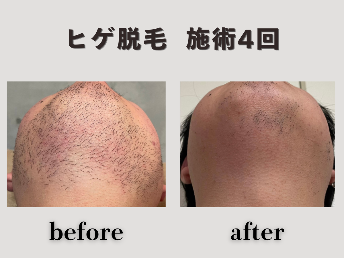 ヒゲ脱毛 施術4回 Before/After