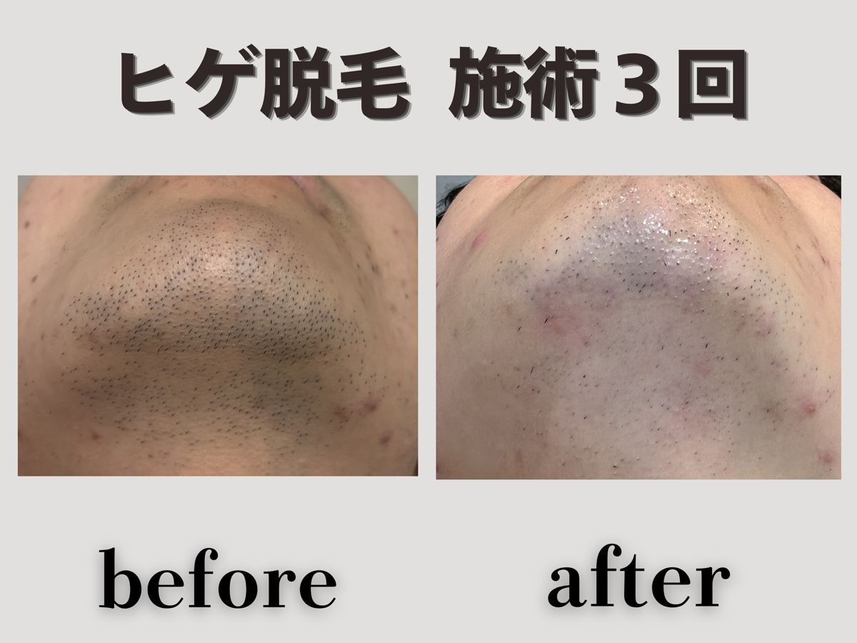 ヒゲ脱毛 施術3回 Before/After