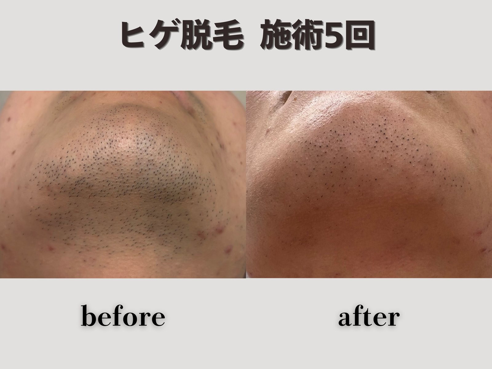 ヒゲ脱毛 施術5回 Before/After
