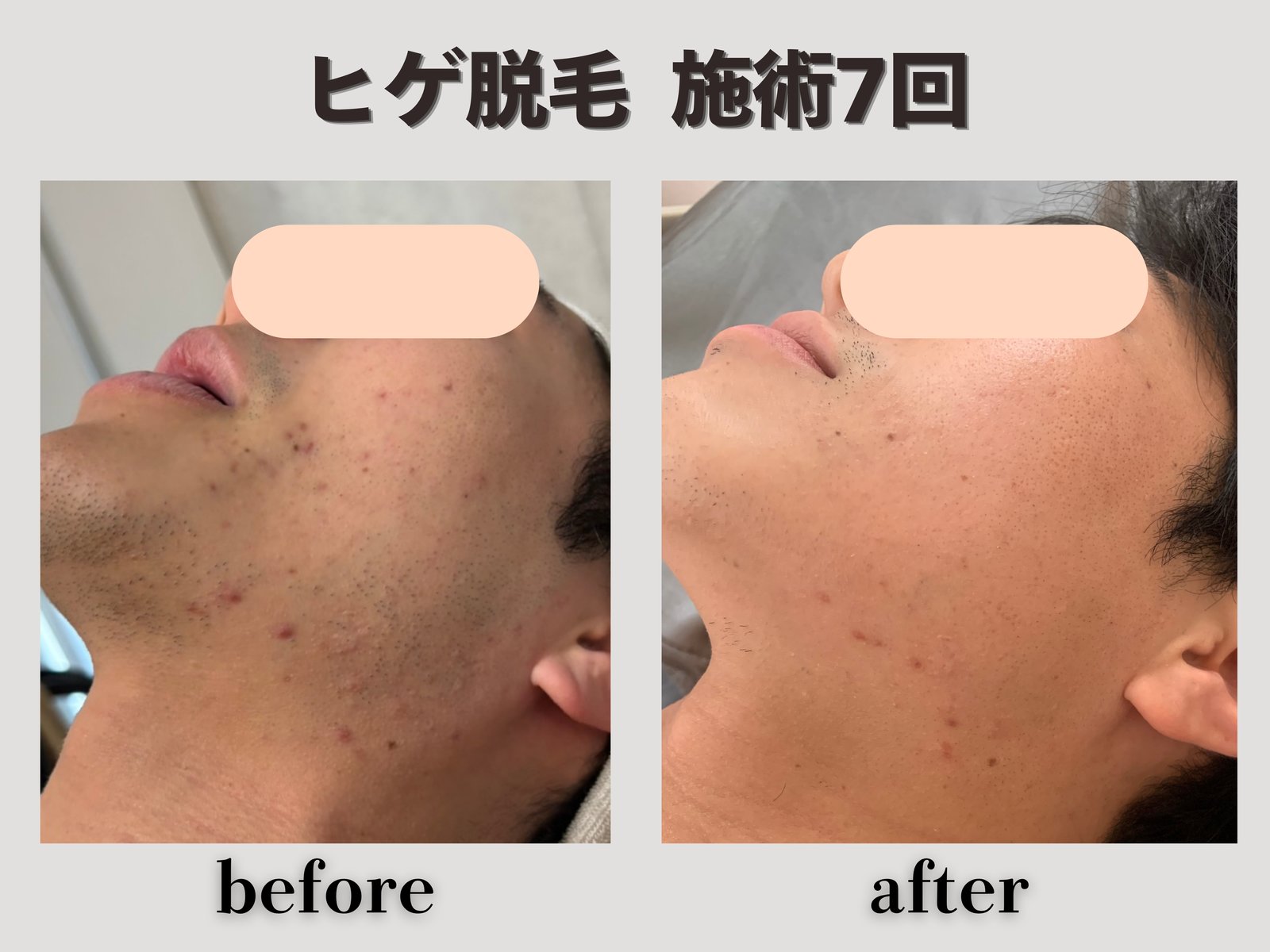 ヒゲ脱毛 施術7回 Before/After