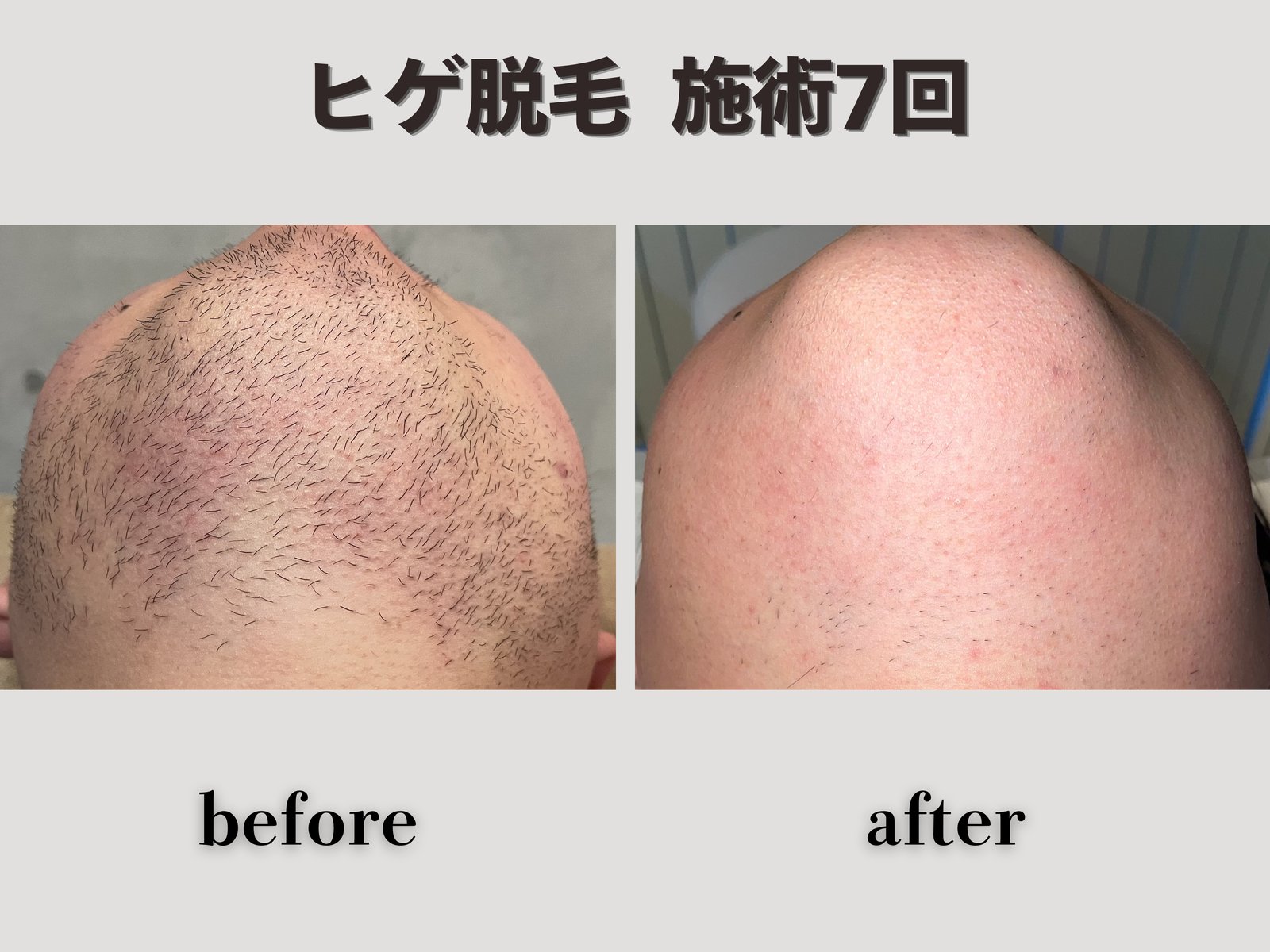 ヒゲ脱毛 施術7回 Before/After